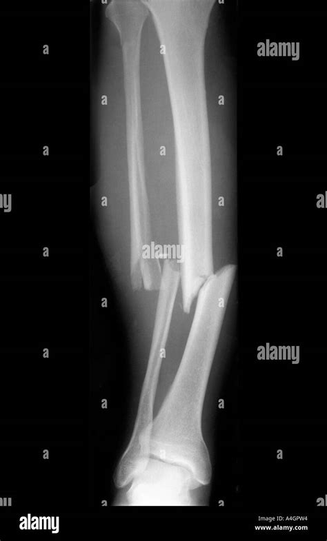 An X Ray Showing A Fracture Of The Tibia And Fibula Of The Lower Leg