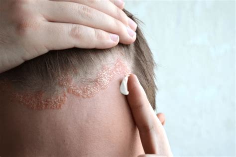 Scalp Psoriasis Overview Causes Symptoms Treatment And Prevention