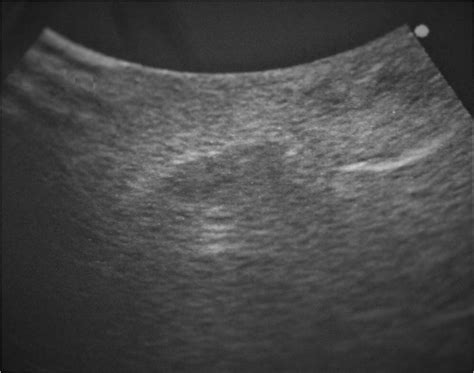 Ultrasound Findings Ultrasonography Reveals A Hypoechoic Mass