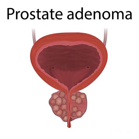 Adenoma Of The Prostate Gland Photograph By Veronika Zakharova Science Photo Library