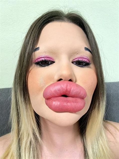 Woman Who Spent K On World S Biggest Lips Now Wants Largest
