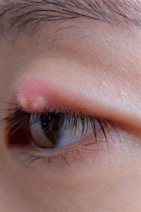 How To Get Rid Of An Infected Eyelash Best Idol Eyelash
