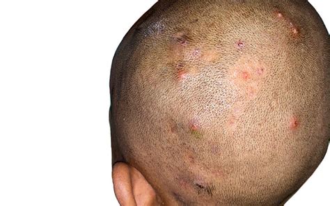8 Types Of Scalp Folliculitis And Ways To Get Rid Of Them 2022