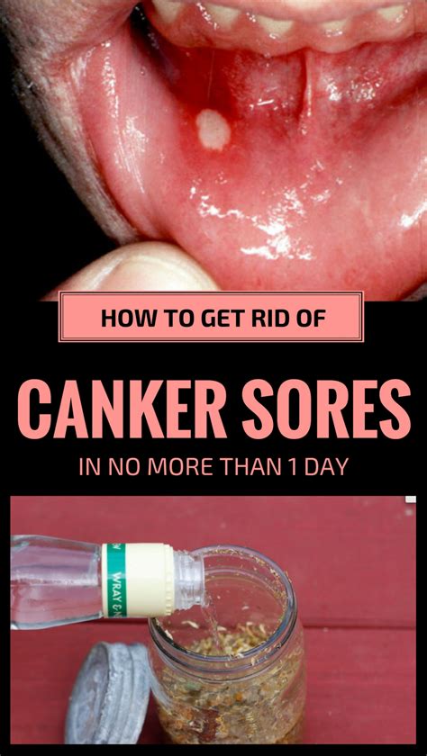 Canker sores (causes, home remedies, treatment, and prevention). How To Get Rid Of Canker Sores In No More Than 1 Day ...