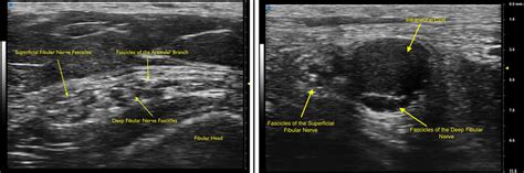 The Value Of High Resolution Imaging In An Occult Peroneal Intraneural