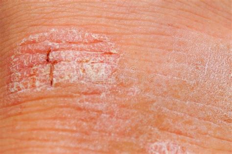 Irritazione Rossa Di Psoriasi E Bianca A Secco Sul Primo ...
