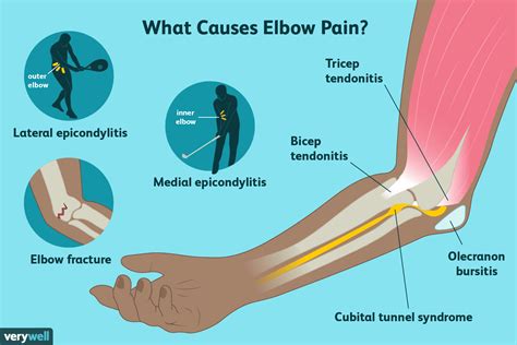 The Culprit Behind Your Elbow Pain And How To Treat It 2023