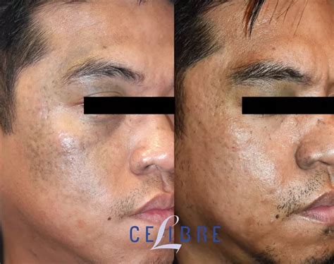 Nevus Of Ota Birthmark Laser Removal