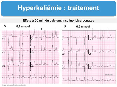 Hyperkaliémie Traitement E Cardiogram