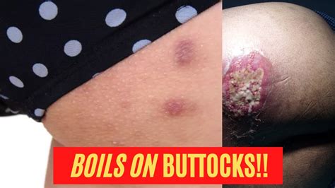 The 7 Most Effective Home Remedies For Boils On Buttocks Boils