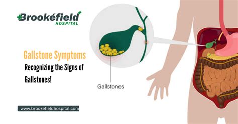 Gallstone Symptoms Recognizing The Signs Of Gallstones Brookefield