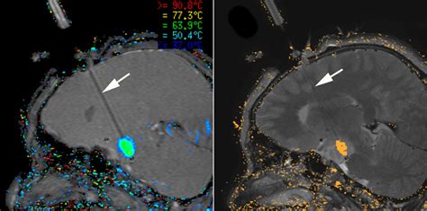 Laser Interstitial Thermal Therapy Litt Ucsf Brain Tumor Center