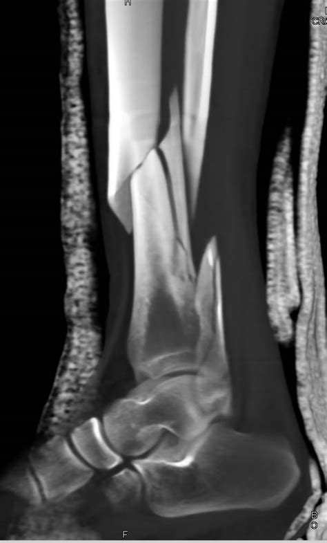 Distal Tibia Fibula Fracture Tlopi