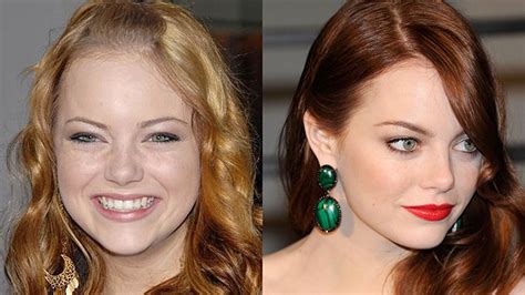 5 Most Shocking Celebrity Plastic Surgery Transformations Before And
