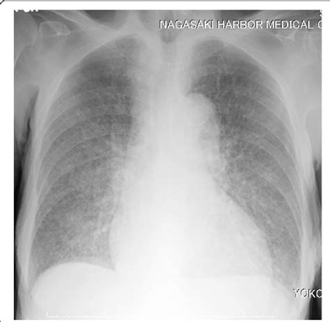 Chest Radiography On Admission Showed Diffuse Micronodules In Both Lung