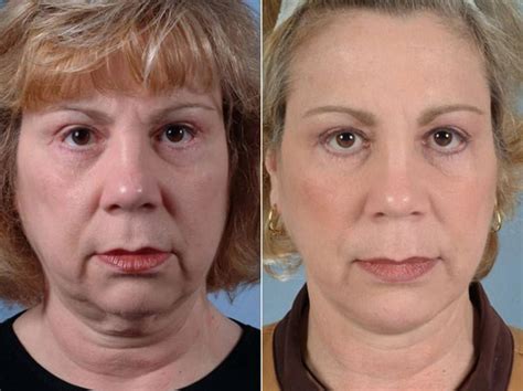 Midface Lift In Philadelphia Pa Before And After Photos Neck Lift