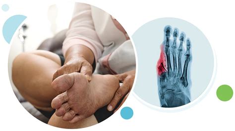Signs Of Diabetic Foot Problems Northstate Foot And Ankle Specialists