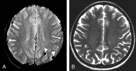 MR Imaging Of The Brain In Patients Cured Of Acute Lymphoblastic