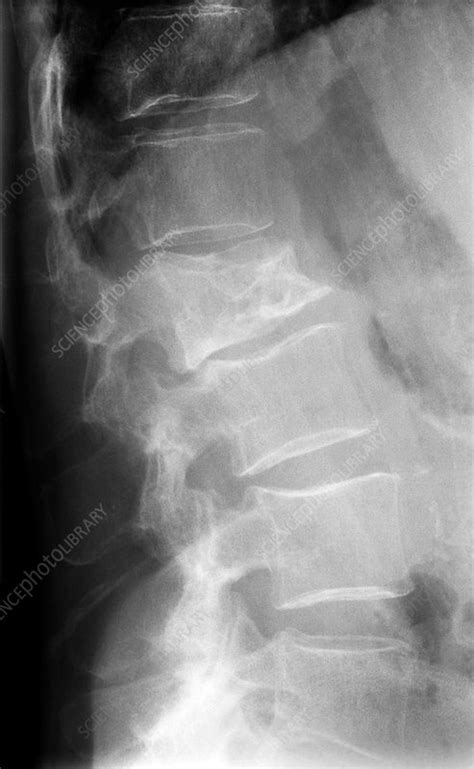 Q can multiple myeloma be found early? Multiple myeloma of the spine, X-ray - Stock Image - C023 ...