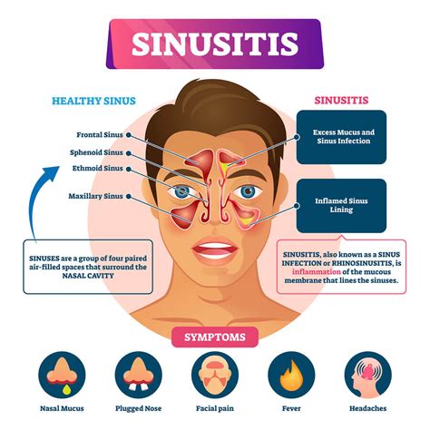 There are only a few antibiotics that can cause a false positive for thc and they are rarely prescribed. The Fastest Way to get a Prescription for a Sinus ...