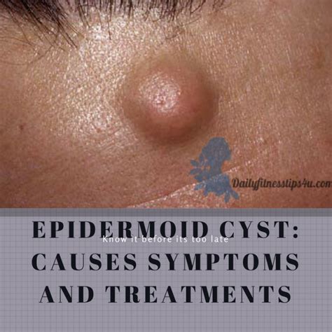 Epidermoid Cysts Causes Picture Symptoms And Treatment