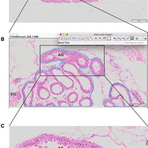 Diagram Of Apocrine Sweat Gland Excision Procedure A Incision Design