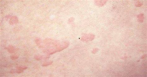 Rash Similar To Frost Bite And Red Hives Could Be New Coronavirus