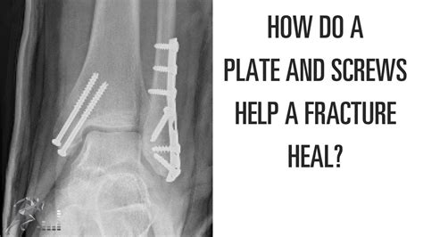 How Does A Plate And Screws Help A Broken Bone Heal Youtube
