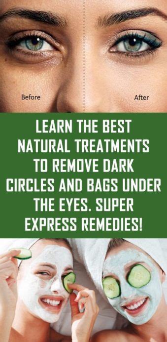 Learn The Best Natural Treatments To Remove Dark Circles And Bags Under