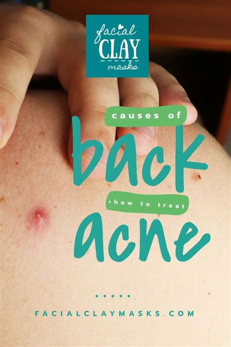 What Are The Causes Of Back Acne How To Treat Back Acne