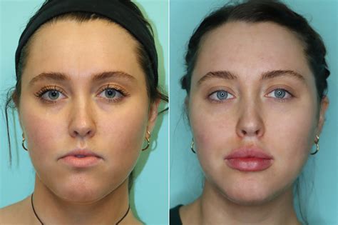 Lip Augmentation Photos Chevy Chase Md Patient