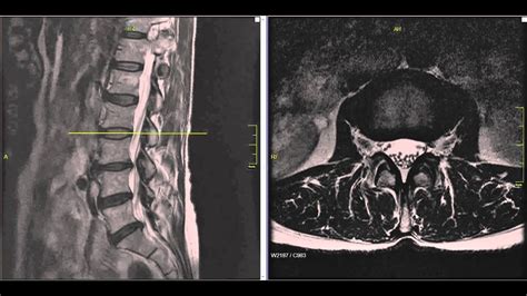 Lumbar Disc Herniation Mri Explained Dr Jeffrey P Johnson Hd