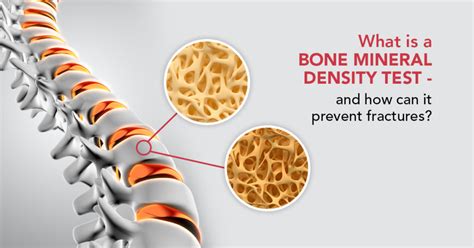 What Is A Bone Mineral Density Test And How Can It Prevent Fractures