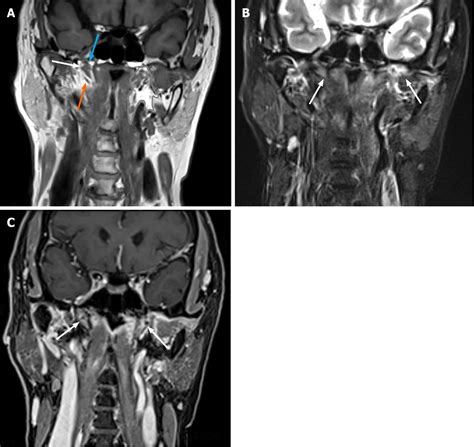 Eustachian Tube Involvement In A Patient With Relapsing Polychondritis