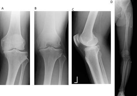 Figure 1 From Simultaneous Anterior Cruciate Ligament Reconstruction