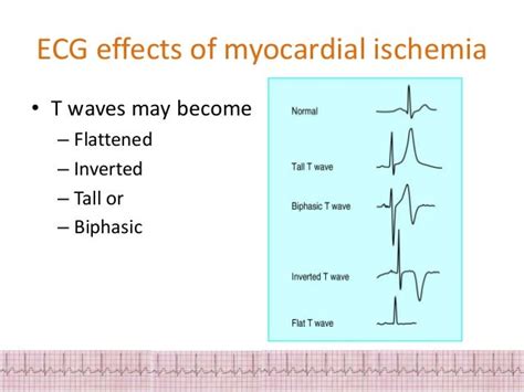 Ecg Changes In Myocardial Ischemia And Injury