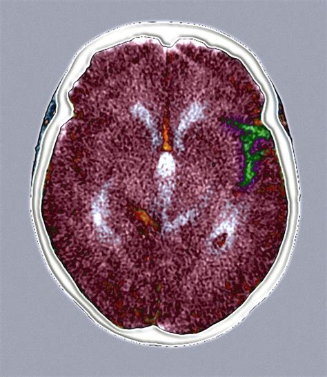 Brain Haemorrhage Ct Scan Photograph By Du Cane Medical Imaging Ltd