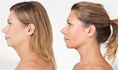 Can You Treat Turkey Neck Richmond Hill Cosmetic Clinic