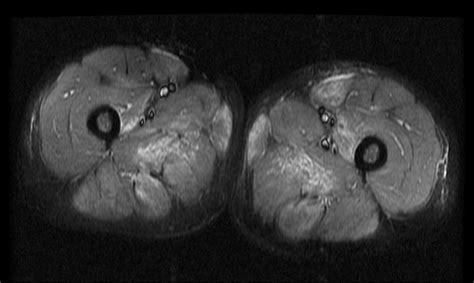 Case 1 Fat Suppressed T2 Mri Thighs Showing Increased Signal In