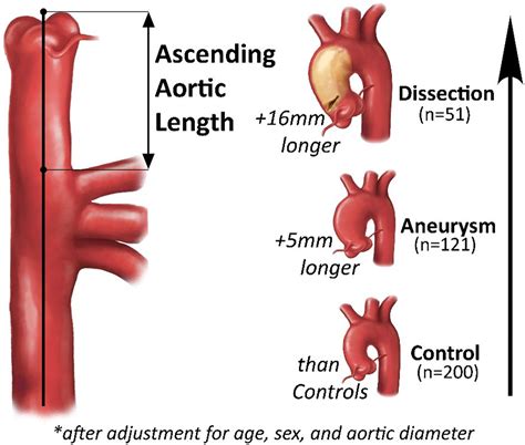 ascending aortic length and its association with type a aortic dissection journal of the