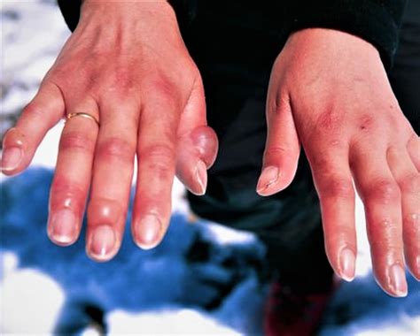 Frostbite Causes Prevention Signs Symptoms And Frostbite Treatment