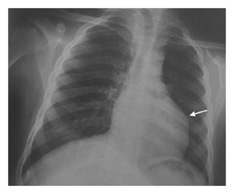 Frontal Chest X Ray Globular Appearance Of The Lower Left Arch Arrow