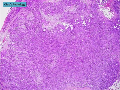 Qiaos Pathology Primary Peritoneal Serous Carcinoma A Photo On