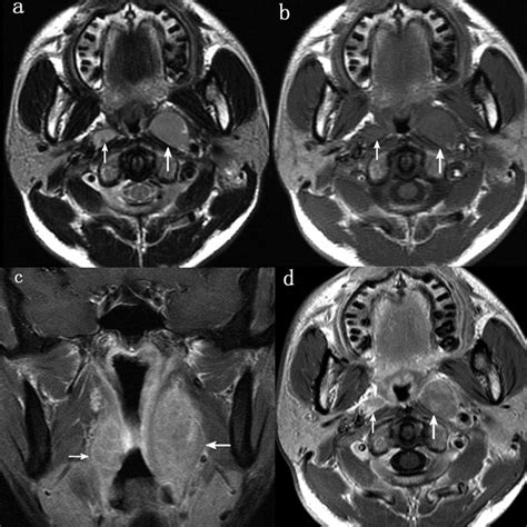 Magnetic Resonance Imaging Of Retropharyngeal Lymph Node Metastasis In