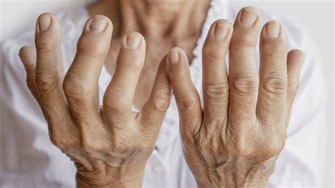 Artrite Reumatóide Conheça Os Sintomas E Tratamentos Clinica Croce