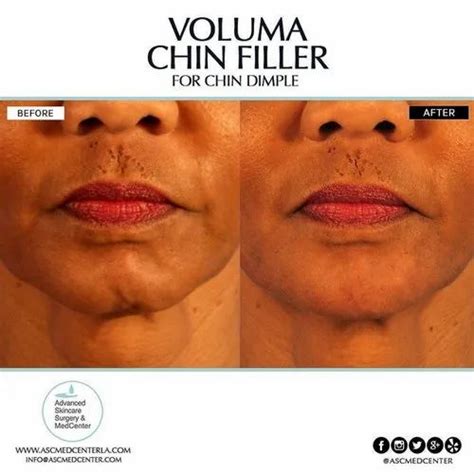 Get Rid Of Double Chin With Botox Treatment At Rs 250unit बोटॉक्स