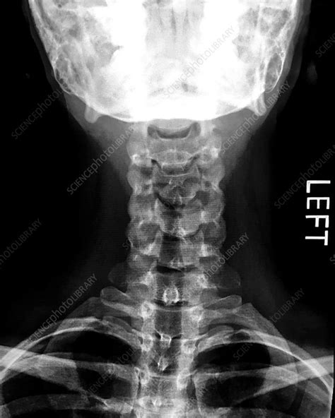 Normal Cervical Spine X Ray Stock Image C0393917 Science Photo