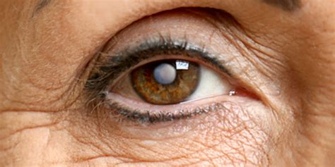 Immediate Sequential And Delayed Bilateral Cataract Surgery May Yield Similar Outcomes