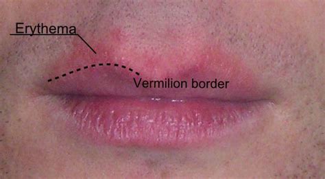 Vermilion Border Alchetron The Free Social Encyclopedia