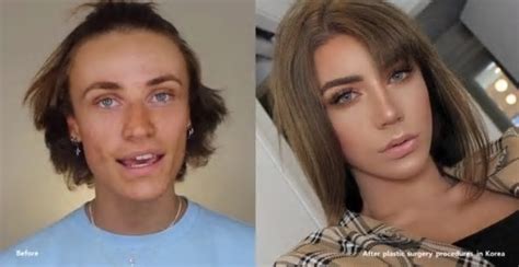 Id Hospital Korea Amazing Transgender Plastic Surgery Transformation Before And After